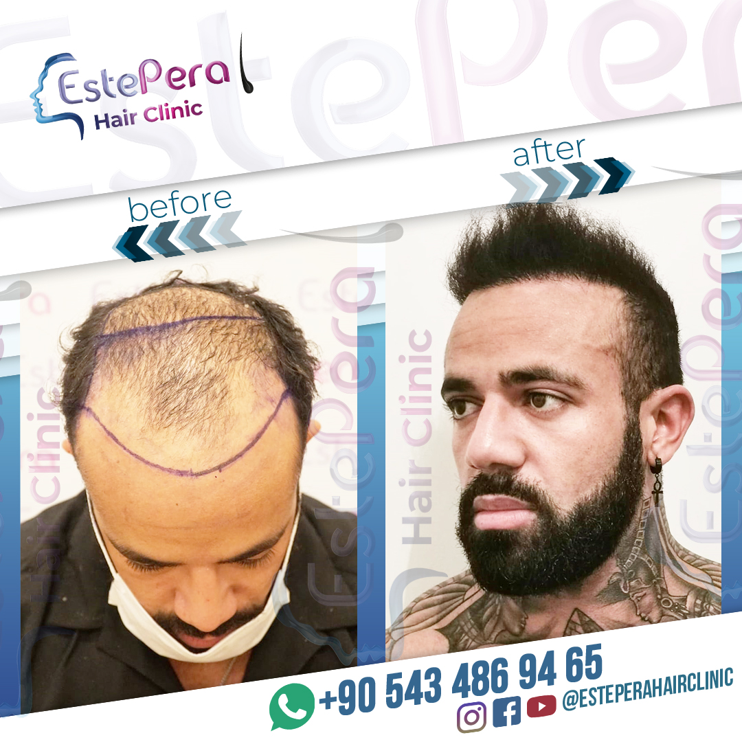 EstePera Hair Clinic on Twitter: 