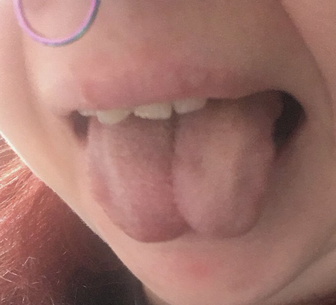 So I have (ankyloglossia) or in laymen&rsquo;s terms an uncut tongue tie, which makes the tip of my tongue