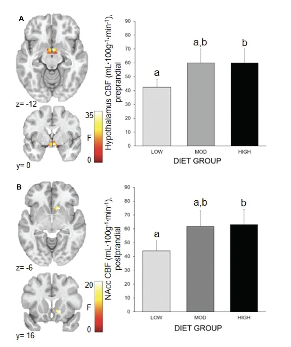 How do carbs affect the brain? 

In one of the biggest feeding studies of this Q, a low-carb (20% cals) diet ⬇️ brain activity in:

👉 Nucleus accumbens ("addiction center")
👉 Hypothalamus (controls hunger &amp; metabolism)
👉 Effects related to ins secretion
academic.oup.com/jn/advance-art…