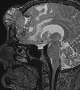 neurosurgatlas's tweet photo. Here is the answer to the most recent #NeurosurgicalAtlas practice exercise. Discussion welcome and encouraged. 
@benkhendricks 
#MedTwitter #Neurosurgery #NSGY #surgery https://t.co/aCU7PQvwKg