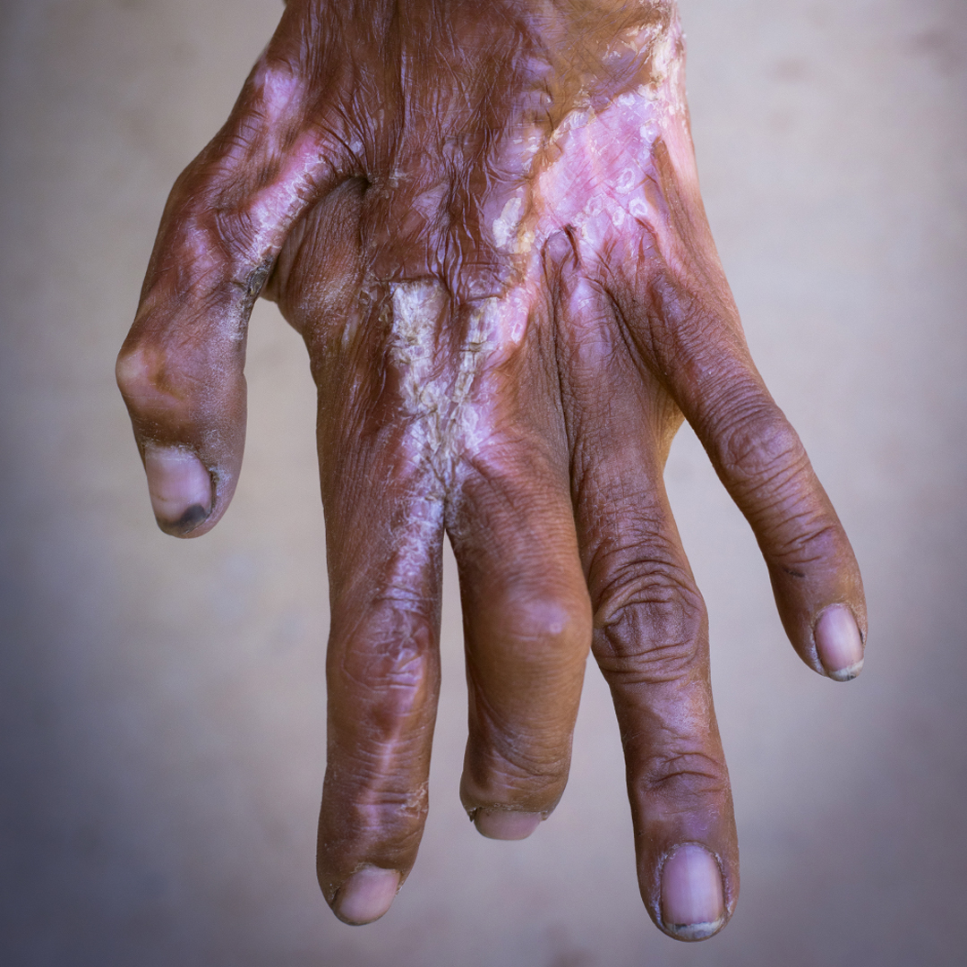 After a burn, the body can experience contractures, a fixed tightening of muscle, tendons, ligaments, or skin preventing normal movement of the associated body part. This can make everyday activities extremely difficult. #FightBurns