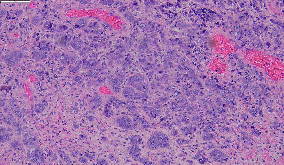 Hello Twitter from the sun and mountains in Denver! 🌄I'm sharing some photos from my collection.  How would you stage this breast cancer? #BreastPath #pathology #Histology #PathTwitter