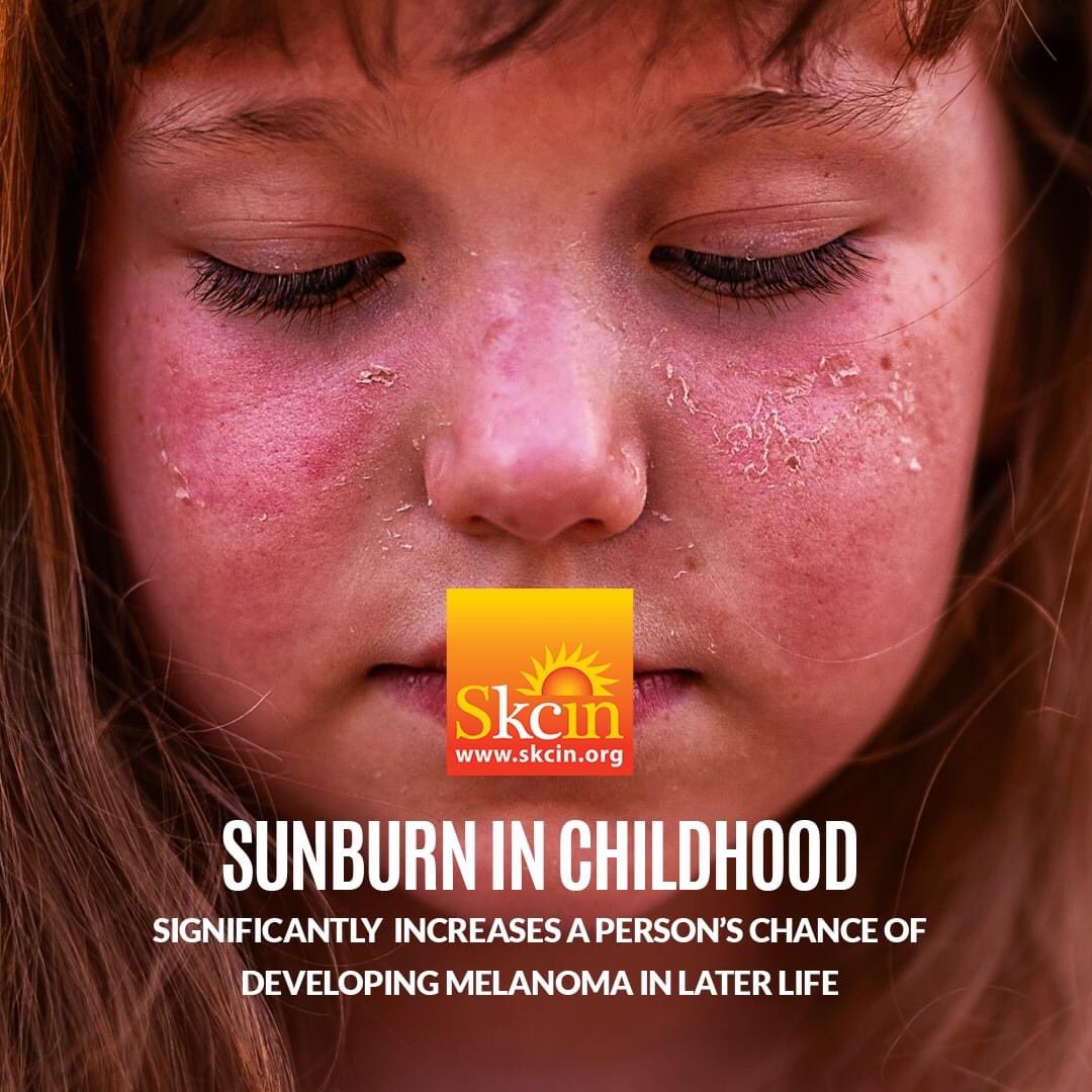 SkcinCharity's tweet image. JUST ONE blistering sunburn in childhood / adolescence more than DOUBLES a person’s chance of developing MELANOMA later in life. A child’s delicate skin can burn MUCH quicker than adult skin, causing IRREPARABLE damage. IS YOUR CHILD’S SCHOOL SUN SAFE? NO? sunsafeschools.co.uk