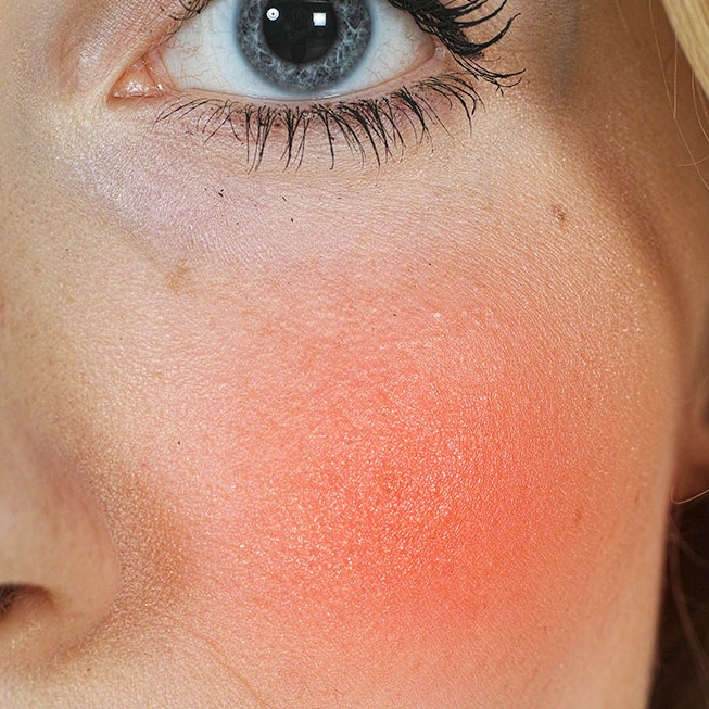 April is #RosaceaAwarenessMonth

Symptoms can range from the typical 'flush/blush' to swollen capillaries &amp; fluid filled pustules resembling acne.

Let us help you find a routine for your skin concerns. Complete our online skin test today!

skintest.facethefuture.co.uk