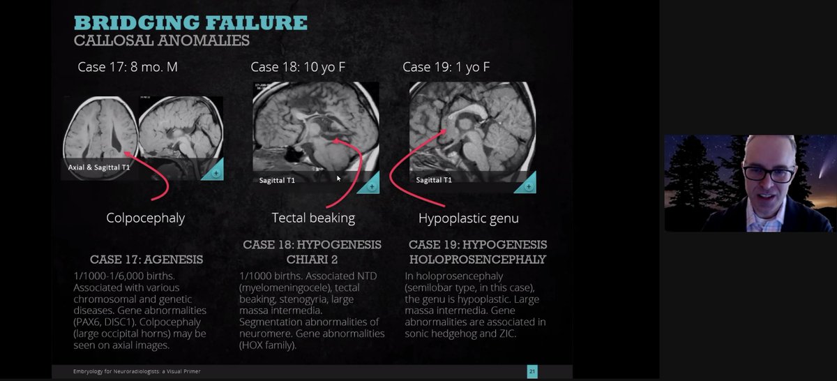 Jay Acharya (@jacharya4) on Twitter photo Honored to have <a href="/jaystarkeymd/">Jay Starkey</a> from <a href="/OHSURadiology/">OHSU Radiology</a> as Visiting Professor for us at @USCneurorads <a href="/RadiologyUSC/">Radiology of USC</a> and providing a fantastic talk on the complex topic of Neuro-embryology and its imaging correlation!
#westcoast #Neuroradiology #PAC12 Honored to have <a href="/jaystarkeymd/">Jay Starkey</a> from <a href="/OHSURadiology/">OHSU Radiology</a> as Visiting Professor for us at @USCneurorads <a href="/RadiologyUSC/">Radiology of USC</a> and providing a fantastic talk on the complex topic of Neuro-embryology and its imaging correlation!
#westcoast #Neuroradiology #PAC12