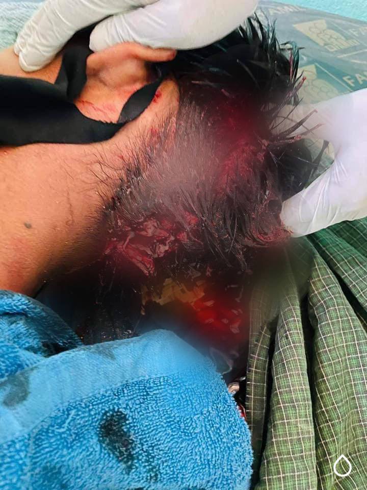 HinLucus's tweet photo. Tw//blood   Myanma junta army shot to protestors in Myonywa.Currently 3 people https://t.co/vyolzO530M is headshot and the onther one got shot in the neck .3rd April 2021 #WhatsHappeninglnMyanmar https://t.co/p9uQby57hB