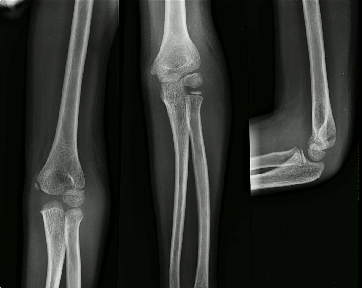 Your next patient is a child who presents with elbow pain after a fall. Wonder if you are missing something on the x-ray? Dr. Ichwan and Dr. Villa are at it again with another EMRad post.

 aliem.com/emrad-ped-elbo…