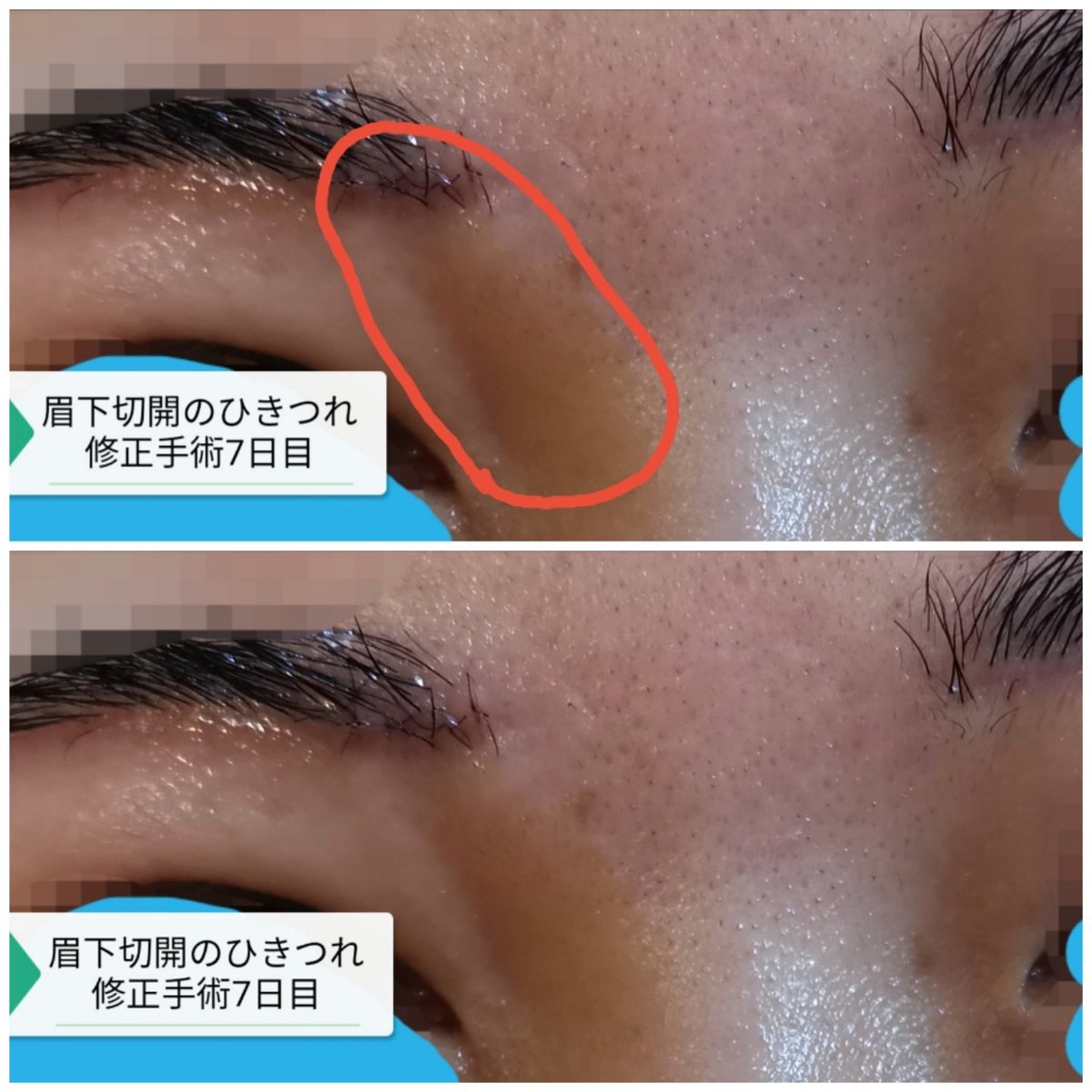 まる まぶたのたるみを切り取る 眉下切開後の引きつれ修正手術7日目 治りません 笑った時にできていたのに真顔でもボコついて見える様になりました 修正できてない 仕事中に鏡に写る自分がふと目に入った 真顔でも引きつれがまぶたに深い影を作っていて