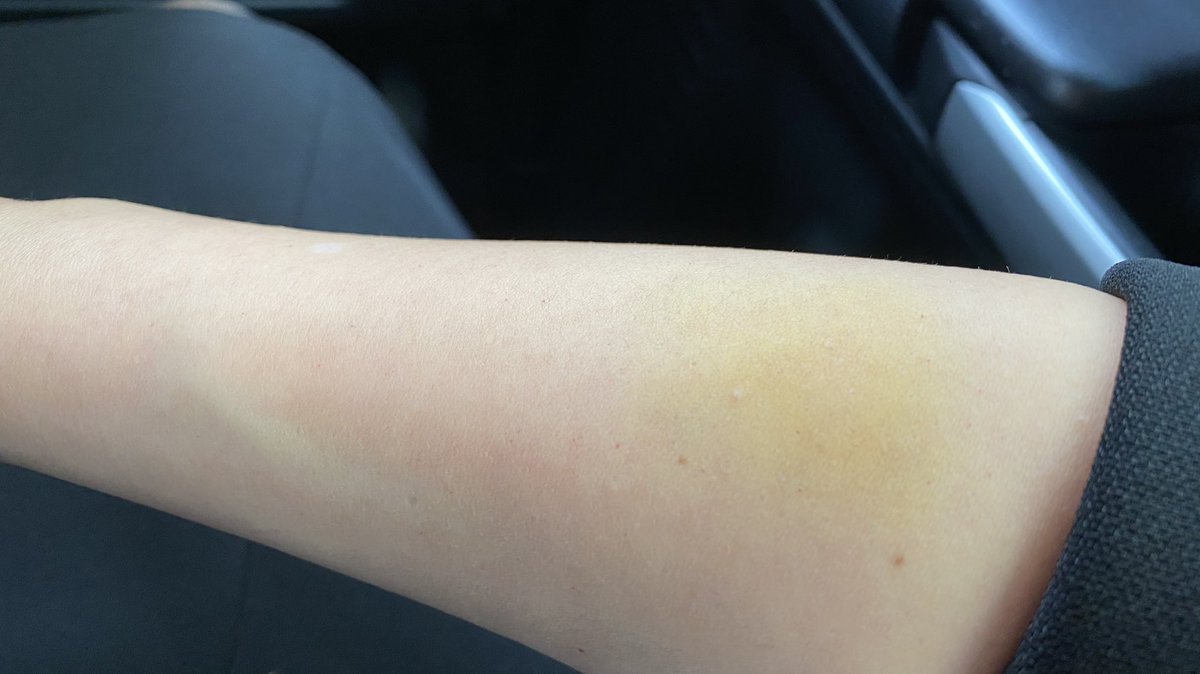 変な色のあざができていた… たぶんスピンバイク運ぶ時にできた