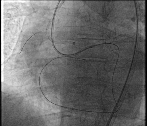Jay Teng (@jayteng) on Twitter photo RCA CTO with old stent hanging into aorta. Unable to engage RCA ostium, went retrograde...retrograde all the way to where??? See comments for a clue and the answer! #tuesdayswithrick <a href="/rickshunk/">rickshunk</a> <a href="/ftmileycathlab/">Interventional Cardiology at Fort Miley</a> <a href="/jlyang5/">Joseph Yang</a> <a href="/jeffreyzimmet/">Jeffrey Zimmet</a> RCA CTO with old stent hanging into aorta. Unable to engage RCA ostium, went retrograde...retrograde all the way to where??? See comments for a clue and the answer! #tuesdayswithrick <a href="/rickshunk/">rickshunk</a> <a href="/ftmileycathlab/">Interventional Cardiology at Fort Miley</a> <a href="/jlyang5/">Joseph Yang</a> <a href="/jeffreyzimmet/">Jeffrey Zimmet</a>