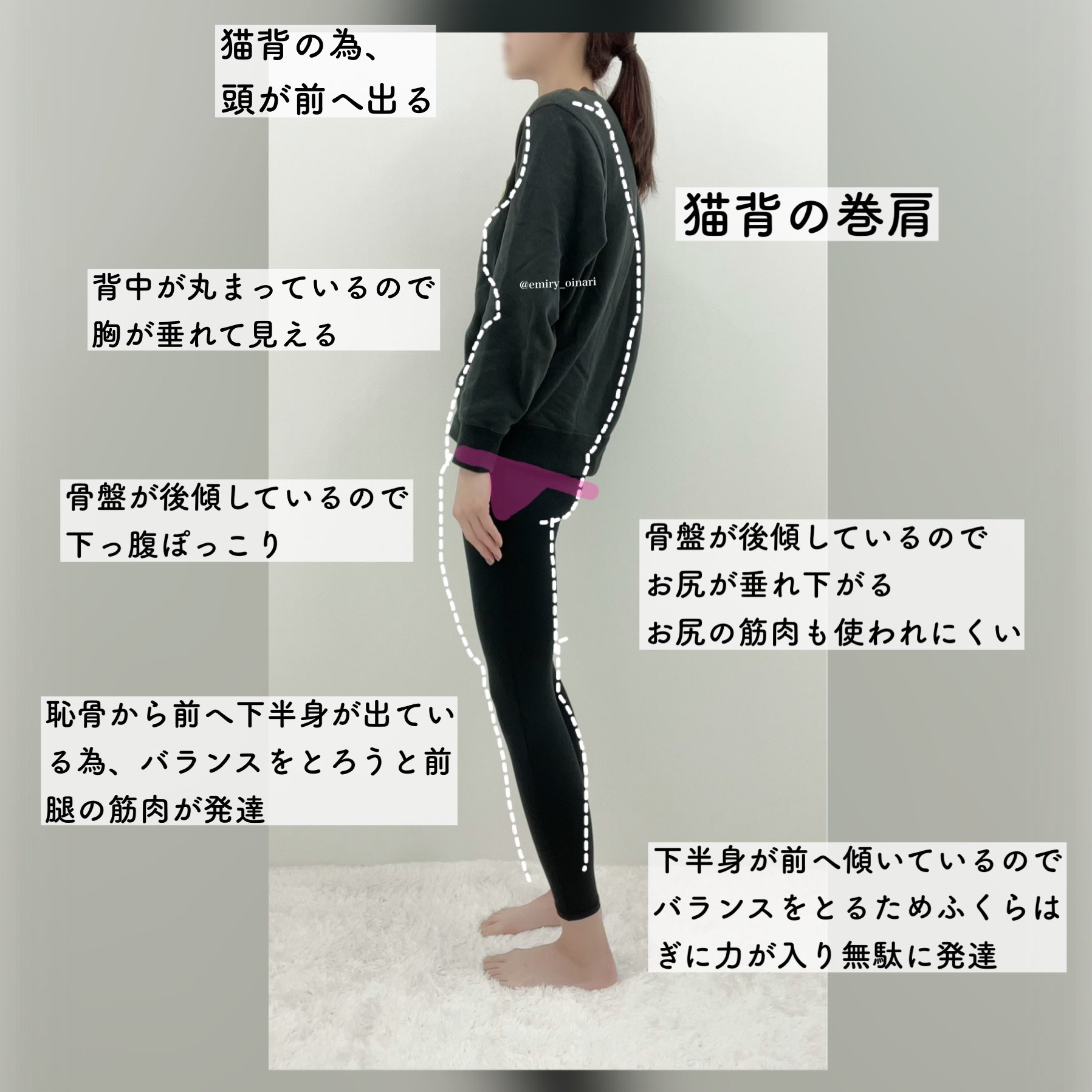 トレえみ 40kg痩せた人 骨盤前傾の反り腰姿勢の人の次は骨盤後傾猫背さんver です この姿勢の人もよく見かけます ストレッチを続けることで姿勢が正しやすくなるのでやってみて下さい ストレッチ後は真っ直ぐ立ちやすくなっている ので やる前と後で