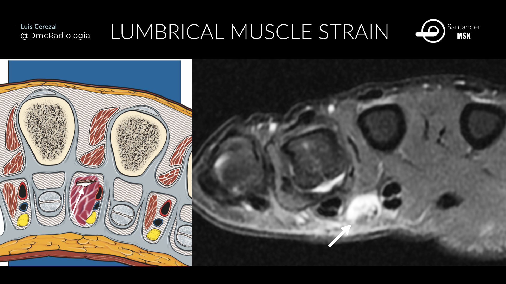 Luis Cerezal on Twitter "34yearold rockclimbing athlete. Lumbrical
