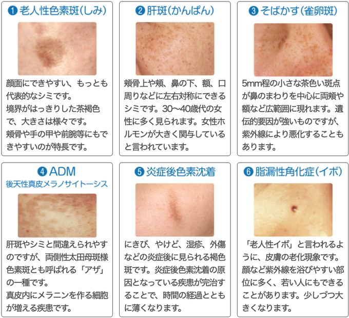 新宿中央クリニック 美容外科公式 在 Twitter 上 シミ には 老人性色素斑以外 に 肝斑 や 脂漏性角化症 など様々な種類があります シミと思っていたものが肝斑や痣という場合もあります 治療法は個々に違いますので専門医による正確な診断が大切です シミの