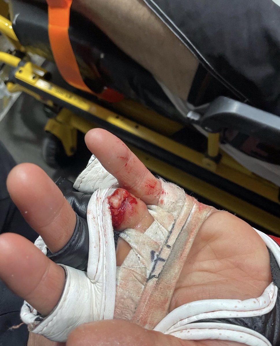 Codigo_Sports's tweet photo. 🤼🇨🇦 El canadiense Khetag Pliev se fracturó y perdió el dedo anular izquierdo por una patada en el #CFFC94. Lo más increíble es que no se dio cuenta en el momento. ⚠️ Atención: imágenes sensibles. Link 👉 https://t.co/uOnMYrJ5mP https://t.co/ejzfMu6TLL