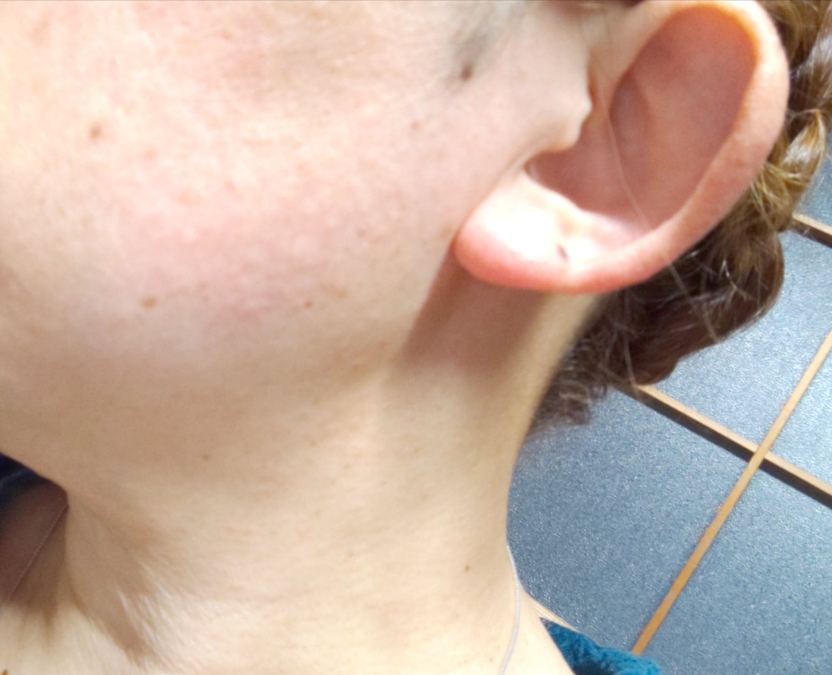 Zoou わかるかな 顔のぶつぶつ首や耳や顔に腕にと増殖中です