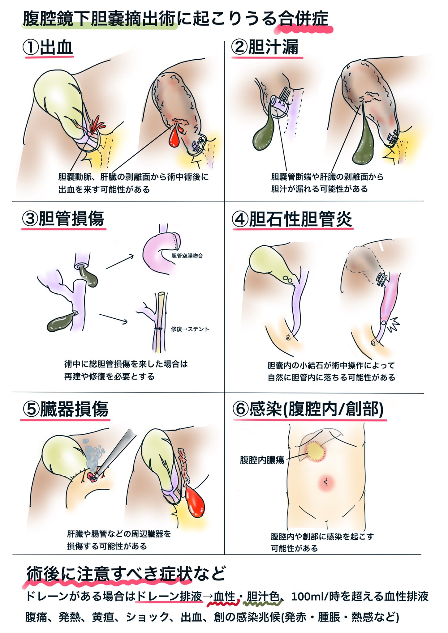 おぺなか 合併症もレクチャー用に描きました 伝わるよう簡単なイラストと文書にまとめてます 術前説明では合併症 について必ず話します 聞いて怖くなってしまう患者さんもいますが それでも敢えて詳細に話すのは 合併症を避けるべく十分に配慮します