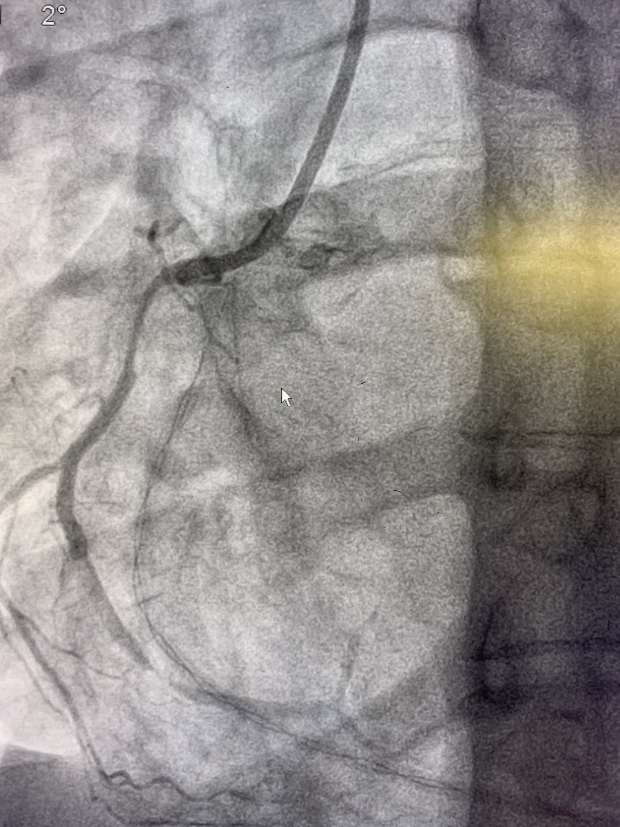 DrJayMohan's tweet photo. Today’s STEMI- Young 20s. Youngest patient I’ve ever done PCI on. She had mild RCA disease in 2019 when she presented with an LAD STEMI. LAD has developed severe ISR already. What’s your youngest STEMI? #FHLD #UnstablePlaque #Cardiotwitter #Cardiology #AccEarlyCareer https://t.co/UeARSGom4u