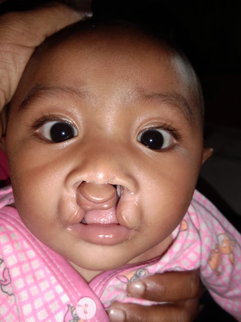 stichtingkolewa's tweet photo. Welkom kleine meid, we staan in de #startblokken om jou te helpen aan een mooie #glimlach voor de rest van je #leven. Nu eerst op gewicht komen met #goedevoeding. 5kg is de regel voor de eerste #operatie op #Bali. #Indonesie #schisis #charity #ngo #doneer https://t.co/PimOHjTweX https://t.co/akDl8pre8g