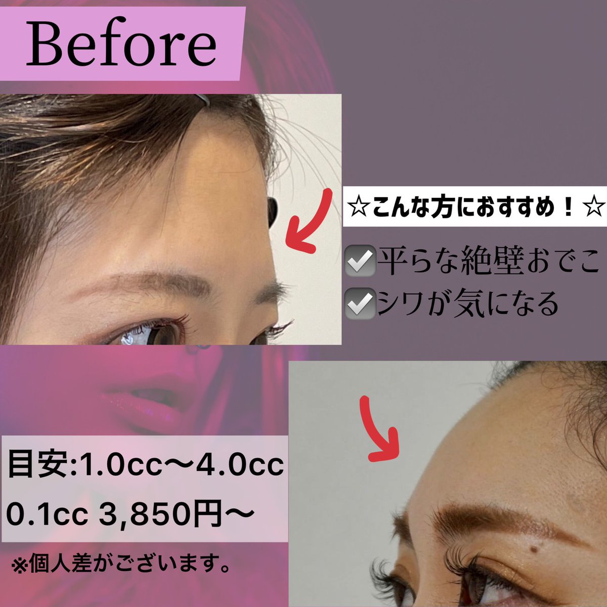 脱 絶壁おでおこ ま るいおでこはお顔の立体感が生まれ女性らしい印象がアップします シワが気になる 前髪なしの髪型にしたいけどおでこが絶壁で似合わない ヒアルロン酸注入 0 1 3 By フィラークリニック 公式 Edayfm