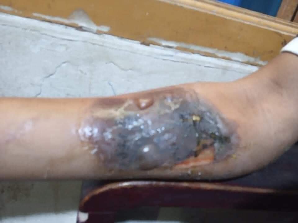 PaingPhyoeThu9's tweet photo. TW // graphic content
The Junta's terrorists burned this man's forearm just because he had "Spring Revolution" tattoo.
#WhatsHappeningInMyanmar
#Apr5Coup https://t.co/J7fMEKdeSf