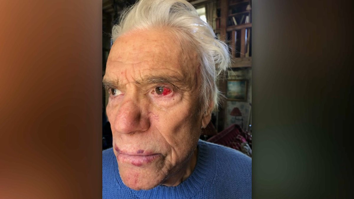 CerfiaFR's tweet photo. 🇫🇷 FLASH | Les #photos des #blessures des époux #Tapie après leur violent #cambriolage.

(BFM) #violence https://t.co/lWuyk4rfYD