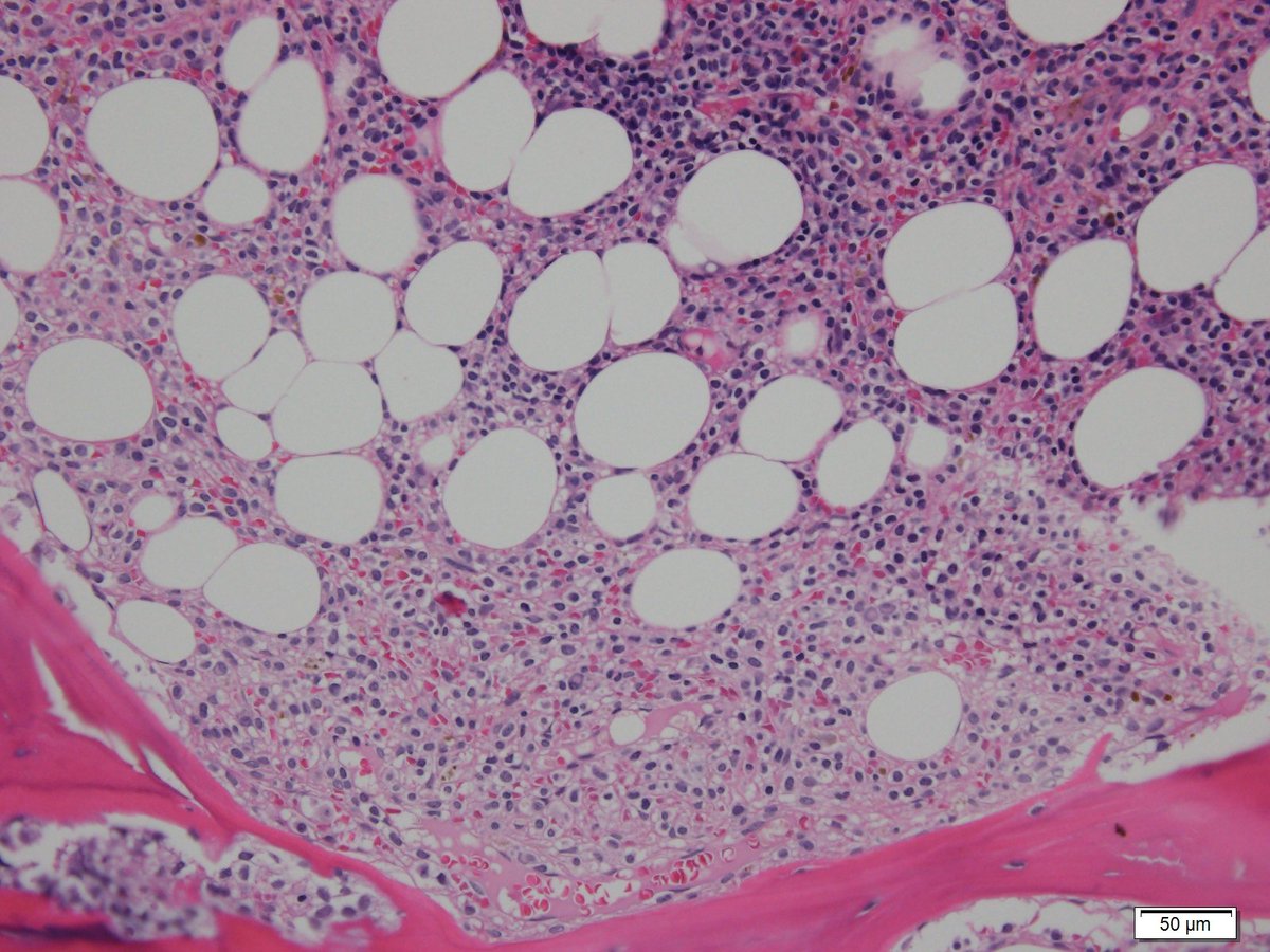 bedi_begui's tweet photo. Tricholeukemia: 
The Hairy Cell Leukemia 💇🏽💇‍♀️💇🏾‍♂️

The abundant pale blue cytoplasm results in a "fried-egg" appearance 🍳

#hemepath #pathresidents https://t.co/InLXupV2iY