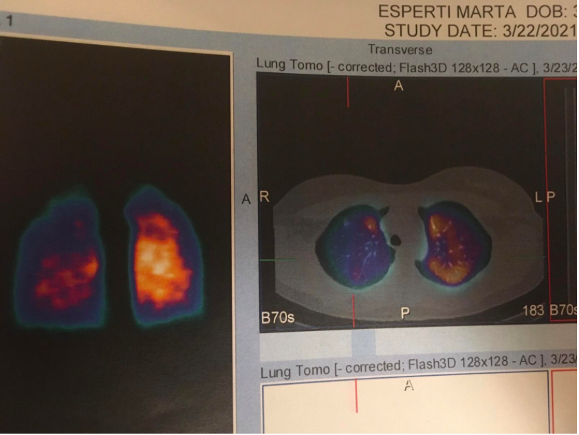 IMPORTANT 🧵 #LongCovid 
After 1 year I found out why I have persistent fatigue, breathlessness, exercise limitation: micro-vascular problems found especially in my right lung through Lung Perfusion (radioactive dye) SPECT/CT.
1/ 👇