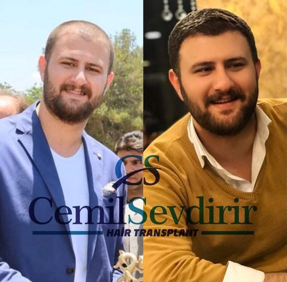 Saçlarınıza yeniden kavuşmak istiyorsanız iletişime geçebilirsiniz  #sacekim #fueteknigi #safir #hair #sactasarim