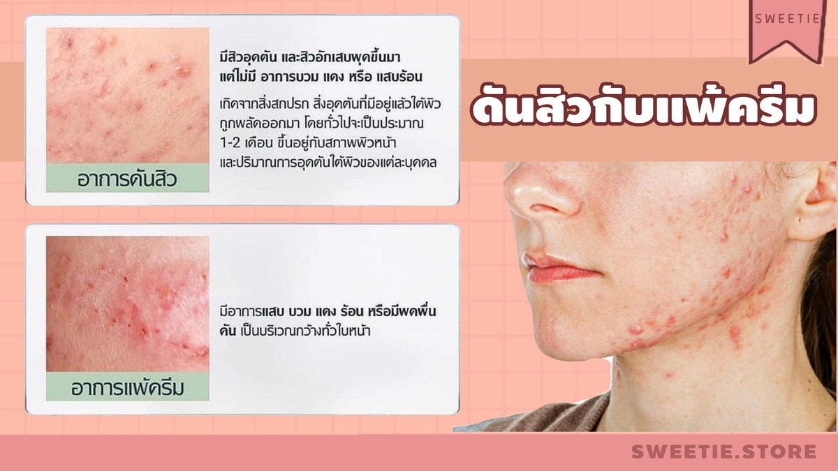 Eucerin ส่งฟรี : sweetie store จบทุกสิวกวนใจ tweet media