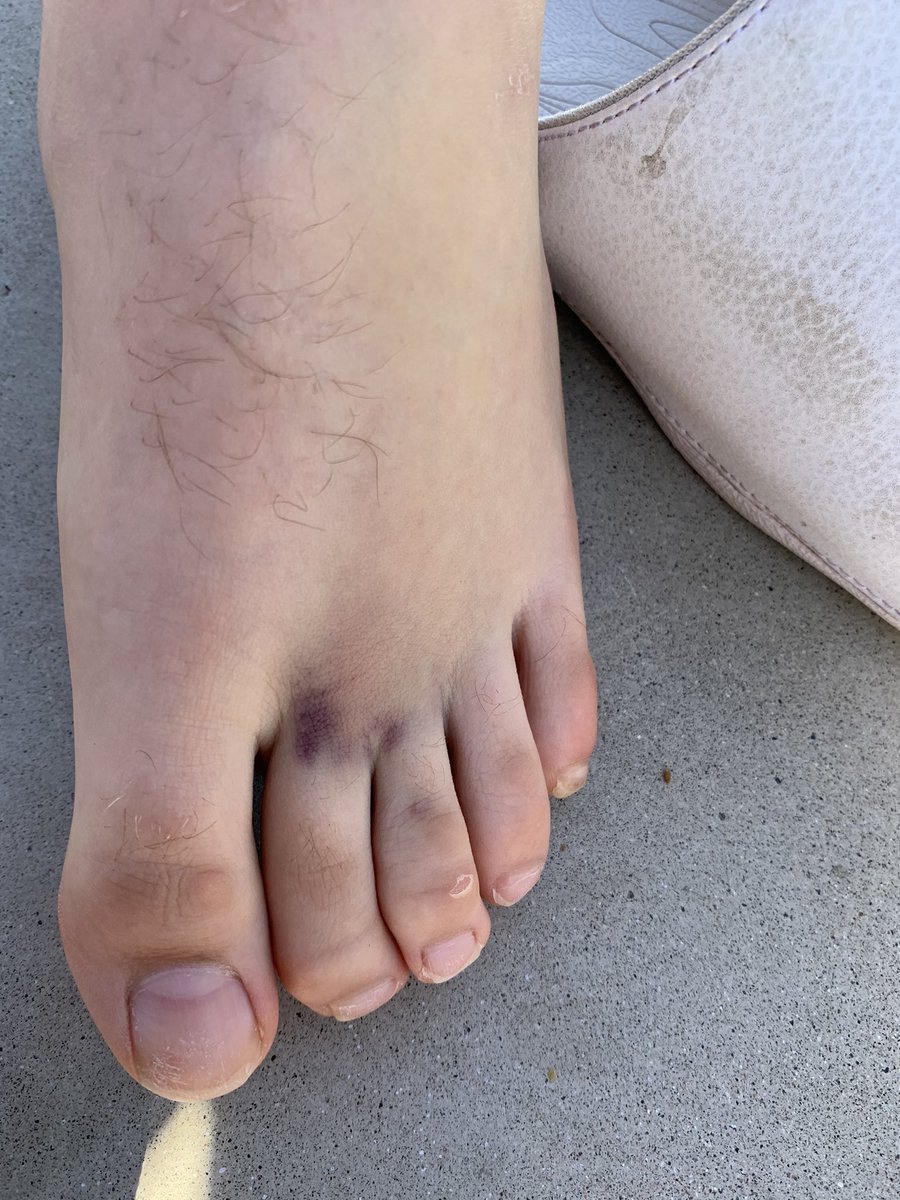 bbaum22's tweet image. Brandon’s battle scar that took him out of the Camas game.. rehabbing in Palm Springs 😜