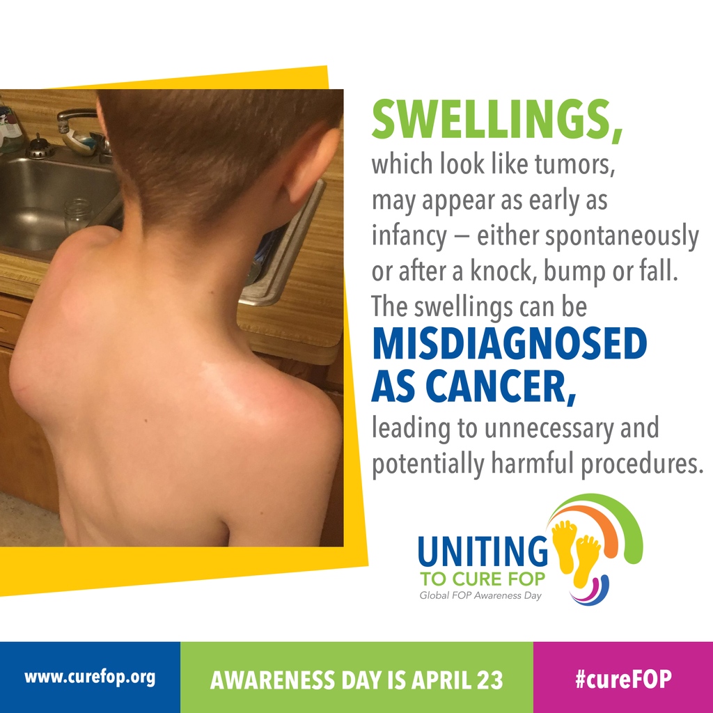 FOPAustralia's tweet photo. Swellings which look like tumors, may appear as early as infancy -either spontaneously or after a knock, bump or fall. Swellings can be misdiagnosed as cancer, leading to unnecessary and potentially harmful procedures #CureFOP#FibrodysplasiaOssificansProgressiva #UnitingToCureFOP https://t.co/mKFKSHjdXB