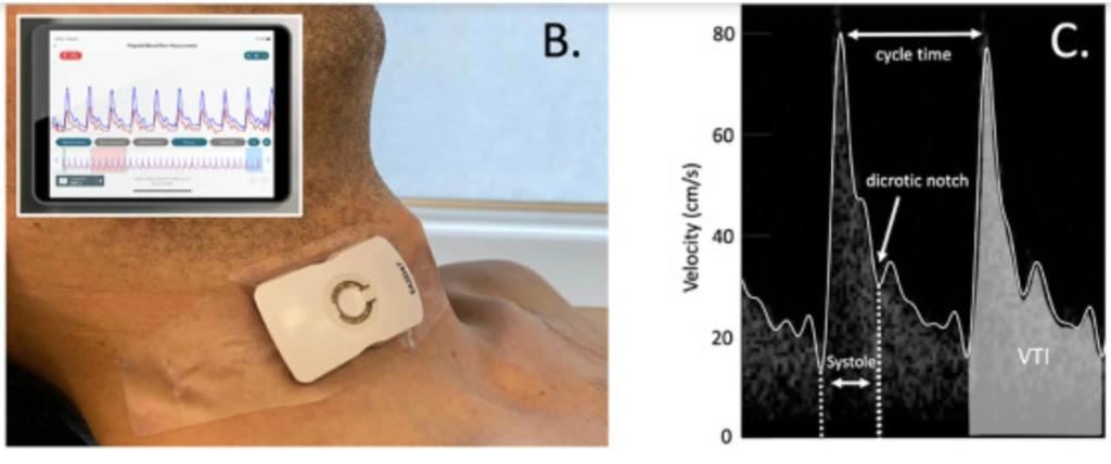 Monitoreo hemodinamico funcional con un parche de ultrasonido inalambrico.

US Doppler a nivel de la carotida para estimar el flujo del tracto de salida del ventrículo izquierdo de forma continua. 

El futuro nos a alcanzado!

jcvaonline.com/article/S1053-…