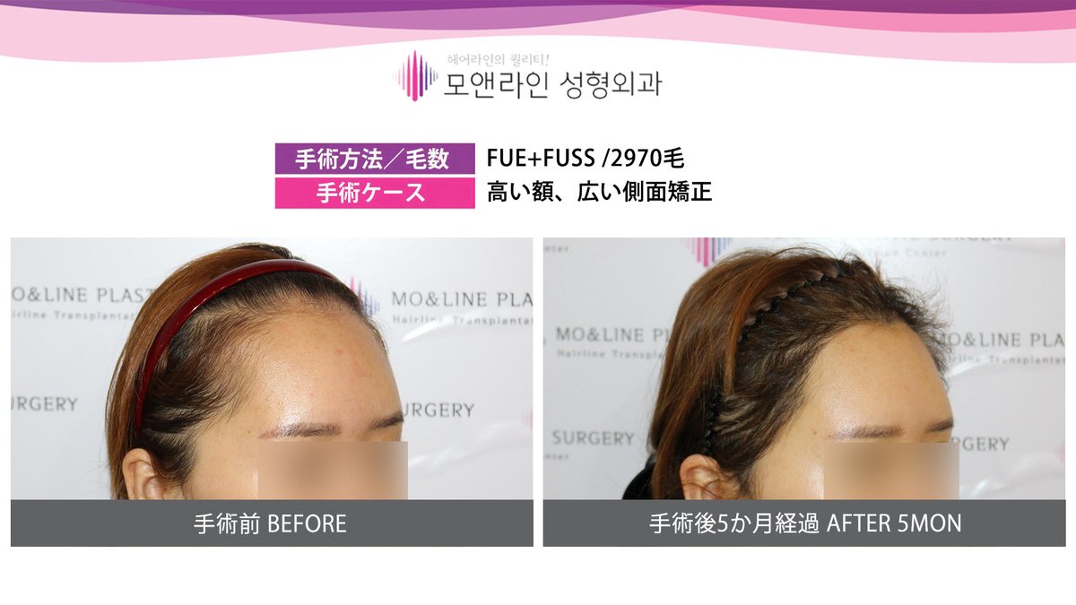 モ ヘアーライン美容整形外科 Molinepsjp Twitter モ ヘアーライン美容整形外科 Molinepsjp Twitter