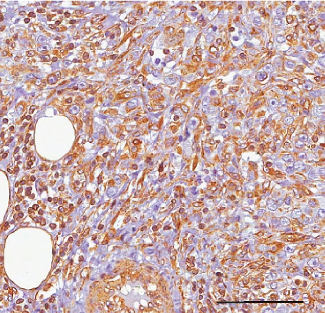 IIT (@iitalk) on Twitter photo Se i risultati ottenuti saranno confermati, le chemioterapie potrebbero in futuro risultare ancora più efficaci, per le forme aggressive di #cancro al #seno.
Ricerca sostenuta da <a href="/AIRC_it/">Fondazione AIRC per la ricerca sul cancro</a> e condotta da F. Nicassio, coordinatore del centro CGS di IIT
opentalk.iit.it/colpire-i-micr… Se i risultati ottenuti saranno confermati, le chemioterapie potrebbero in futuro risultare ancora più efficaci, per le forme aggressive di #cancro al #seno.
Ricerca sostenuta da <a href="/AIRC_it/">Fondazione AIRC per la ricerca sul cancro</a> e condotta da F. Nicassio, coordinatore del centro CGS di IIT
opentalk.iit.it/colpire-i-micr…