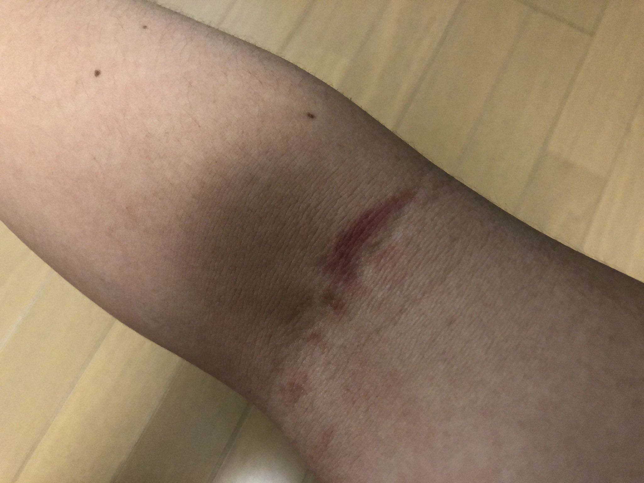 やべきょうすけ ところで この内出血と青タンは何だ まぁ 年中夢中で仕事した ってことだな Ww T Co Qf8ghfaio0 Twitter やべきょうすけ ところで この内出血と青タンは何だ まぁ 年中夢中で仕事した ってことだな Ww T Co Qf8ghfaio0 Twitter