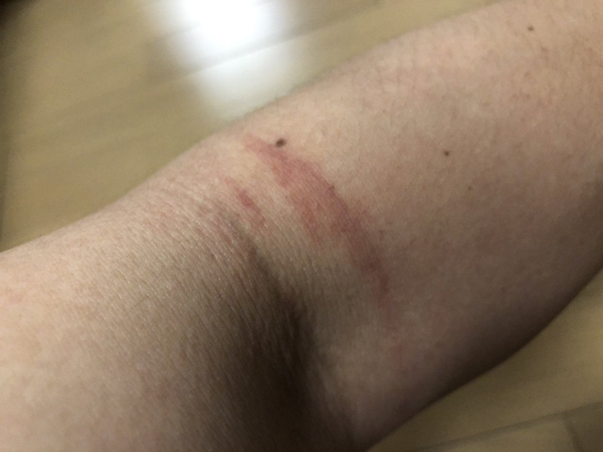 やべきょうすけ ところで この内出血と青タンは何だ まぁ 年中夢中で仕事した ってことだな Ww T Co Qf8ghfaio0 Twitter