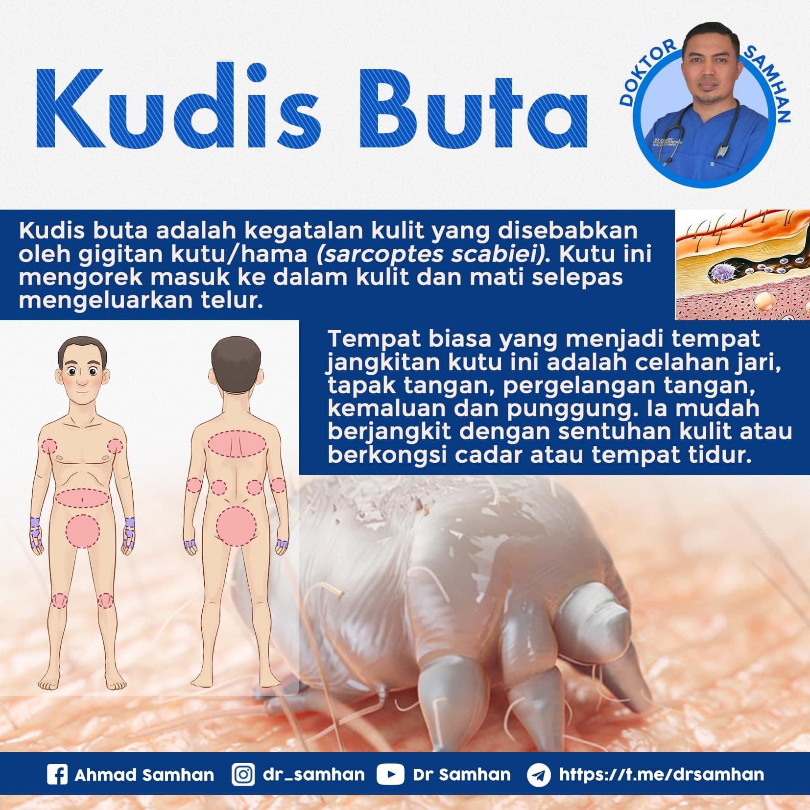Twitter ä¸Šçš„ Dr Samhan Ya Allah Gatalnya Tak Boleh Bincang Makin Digaru Makin Sedap Berdarah Pun Tak Sedar Kudis Buta Atau Skabies Ialah Keadaan Kegatalan Pada Kulit Yang Disebabkan Oleh Gigitan Kutu Yang