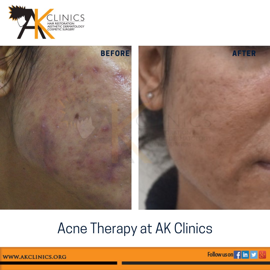 amanakclinics's tweet photo. Treating acne can involve different types approach including customized medical therapy and procedures to prevent acne scarring. Presenting before n after pics of Acne patient treated with both medical therapy and series of Carbon toning with alternate black peels. happy patient https://t.co/UFyxdChJXZ