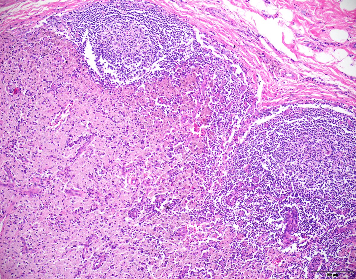 KyleBradleyMD's tweet image. What do you see in the interfollicular region of this lymph node?

What is the most likely etiology for this finding?

#hemepath