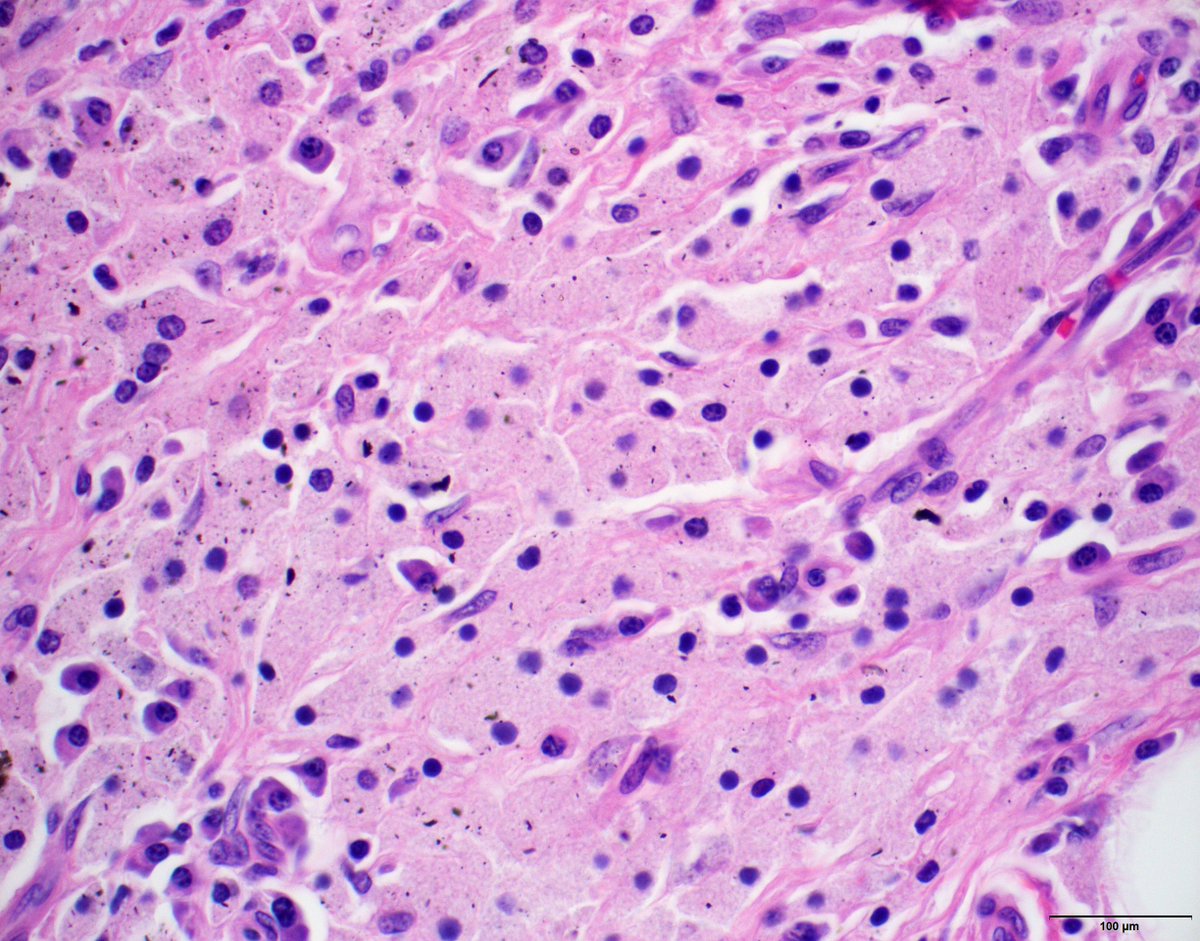 KyleBradleyMD's tweet image. What do you see in the interfollicular region of this lymph node?

What is the most likely etiology for this finding?

#hemepath