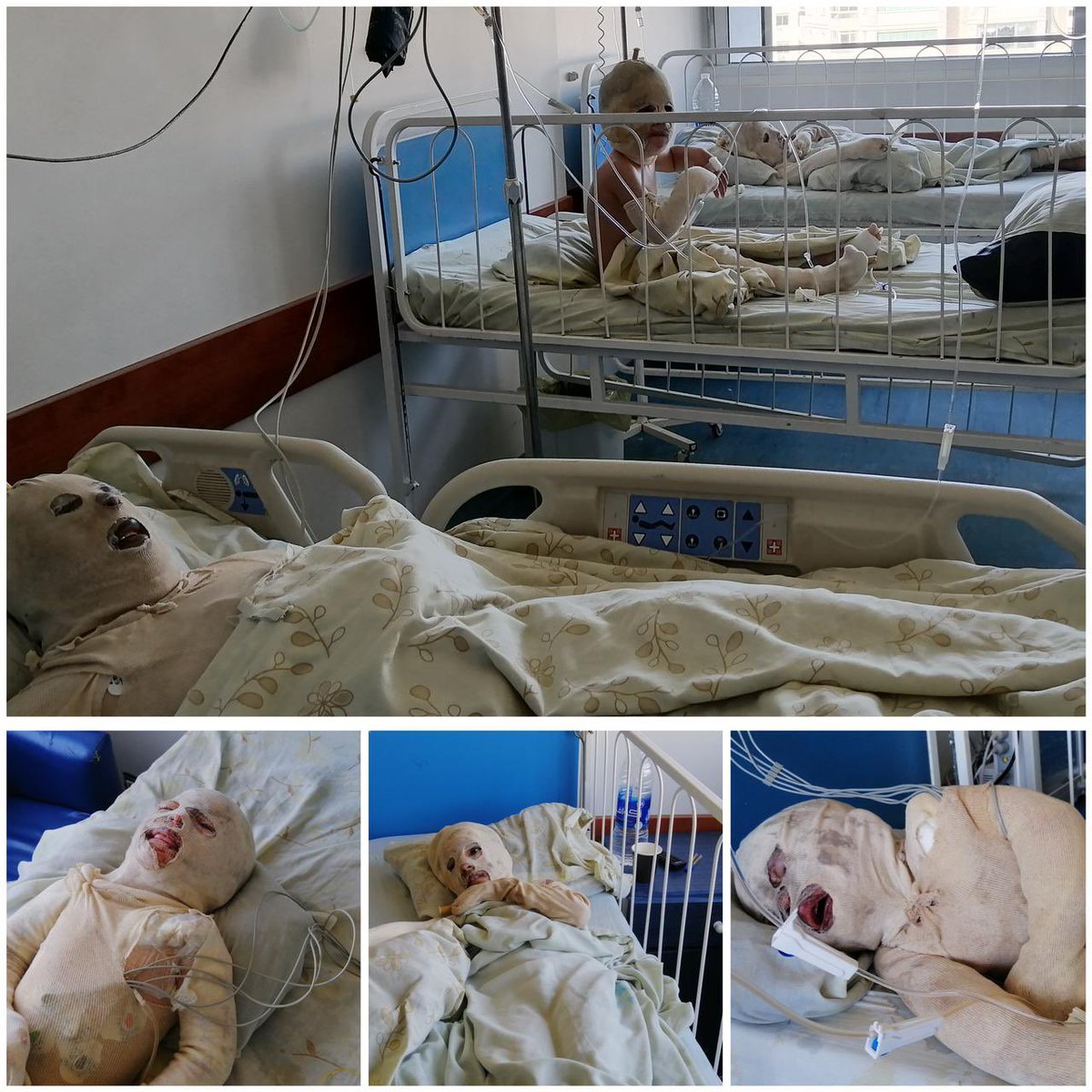 #حالة_مستعجلة 🔺
بثانية وحدة انفجرت جرة غاز ببيت، غيّرت مصير عائلة كاملة..

أربع أطفال لسا ما وعيوا من الحروق الكبيرة اللي اتعرضولها، ولسا ما عرفوا إنهم خسروا أغلى شخصين على قلبهم.. وإنهم صارو بلا أب أو أم!
الحريق أثّر على معالمهم، وسبّبلهم حروق واسعة بكامل الجسم...