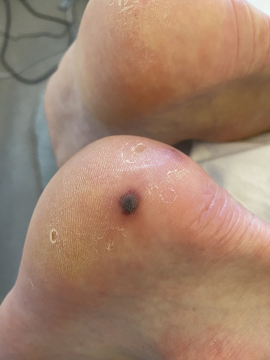 PeteReed's tweet photo. Not exactly a clickbait photo of my heel, but the #1 worst thing about Spinal Cord Injury is 👉Skincare👈
•
For those of you who are also interested in the unseen bad bits.
#SCIAwareness #Number1 #Nursing #NursesKnow #LuckyThisTime #Hygiene #Pockets #Skincare #PressureSore https://t.co/h8LQl5VCrS