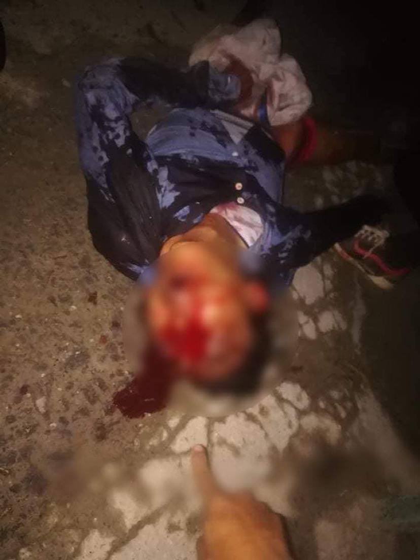 Amanda86601340's tweet photo. In NyaungShwe, Military junta terrorists shot a civilian with real bullets just because he was banging pots and pans. The bullet hit the eye and now in critical condition. One civilian was also shot to the arm. 
STOP INTERNET SHUTDOWN 
#WhatsHappeningInMyanmar 
#Apr6Coup https://t.co/4rDZVv45jc