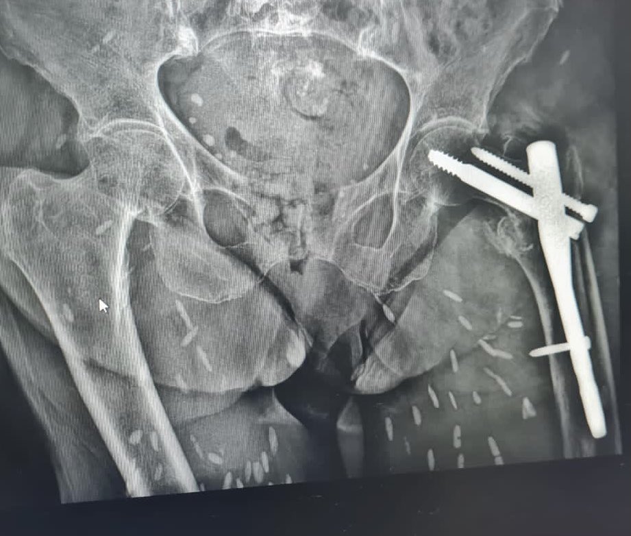 Ramirozg's tweet image. What can you see here, besides the trochanteric refracture? #imagequiz #orthotwitter #MedTwitter