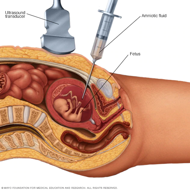 that's known as amniocentesis with a needle, and it would not become public for years to come. however, it is rarely used now, as there are more advanced methods.