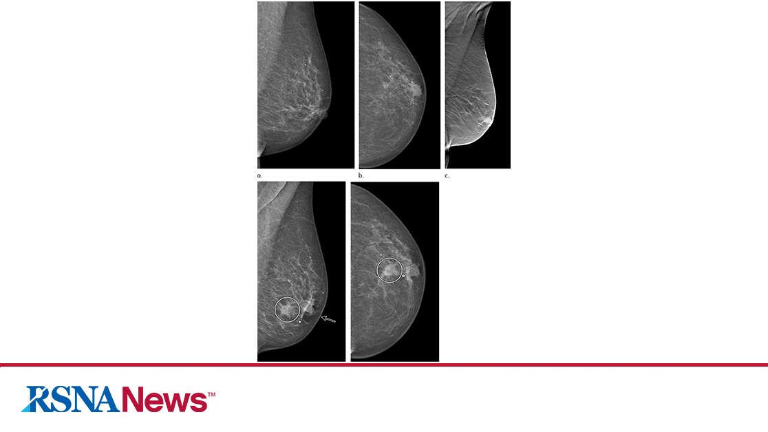 RSNA's tweet photo. Screening with digital breast tomosynthesis reduces the rate of interval breast cancers compared to screening with digital mammography, according to a study published in @radiology_rsna: https://t.co/KWRHHg0hui #BreastImaging https://t.co/NyBMxJizl6