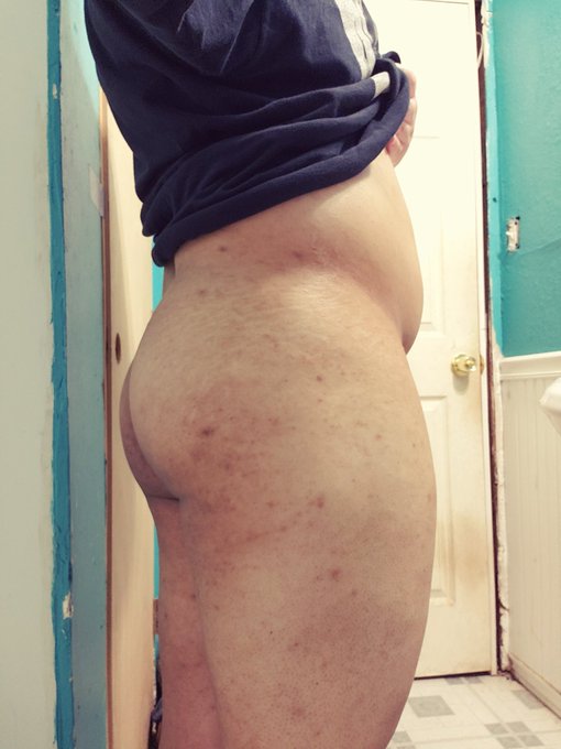 My skin is so bad... https://t.co/kFwAmR7H2g