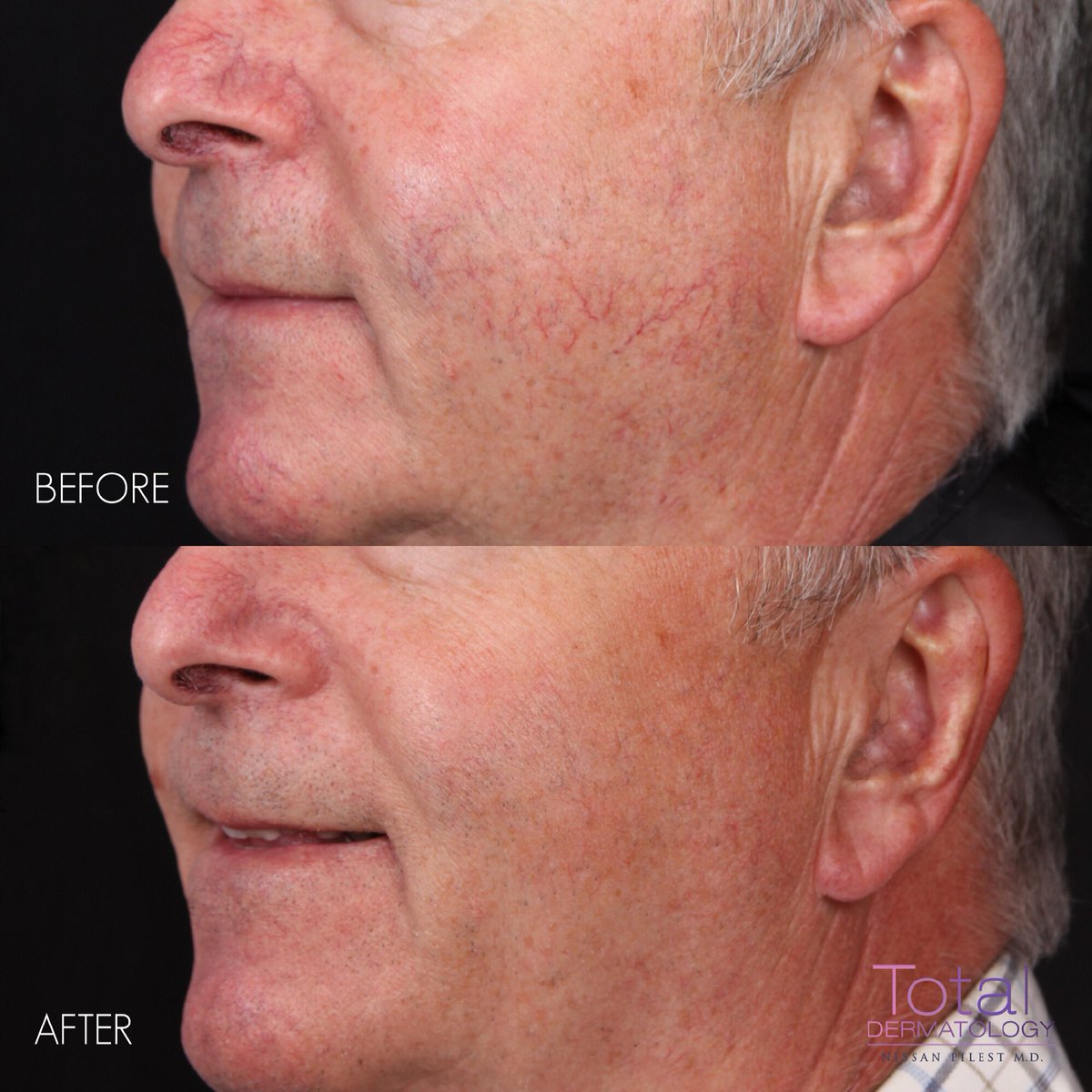 totaldermOC's tweet photo. 😡 If your rosacea’s got you seeing red—figuratively and literally—it may be time to seek out treatment. Rosacea can be treated with both 💊 oral and topical medications, 🧴 the proper skincare, and with 💥 laser treatment such as the Vbeam. #beauty #RosaceaAwarenessMonth https://t.co/XVwO1IsfYG