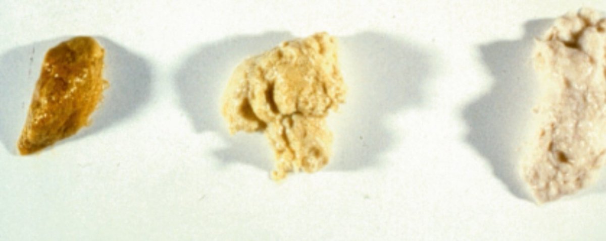 Anne Njom Nlend S Tweet Beaucoup De Parents S Inquietent De La Couleur Des Selles De Bebe Seules Des Selles Decolorees Partiellement Ou Completement Image Milieu Et Gauche Constituent Une Urgence Et Doivent