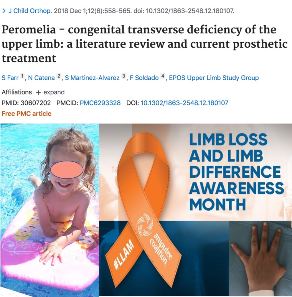 Abril es el mes de las personas con miembros amputados o malformaciones.
Adjunto un artículo científico de nuestro grupo de expertos en extremidad superior y microcirugía de la EPOS (European pediatric orthopedic society)